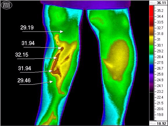 Применение контактной термографии в пограничных областях хирургии