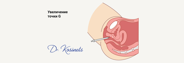 Уменьшение влагалища